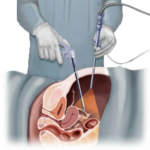 laparoscopic surgery